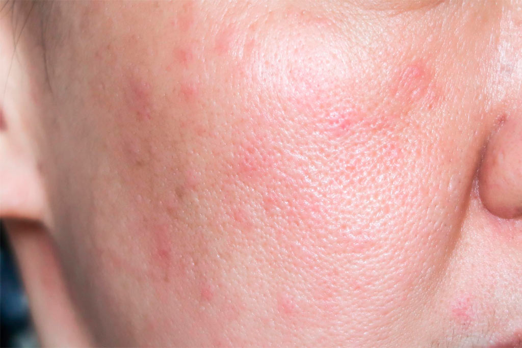  la alergia causa granos en la cara