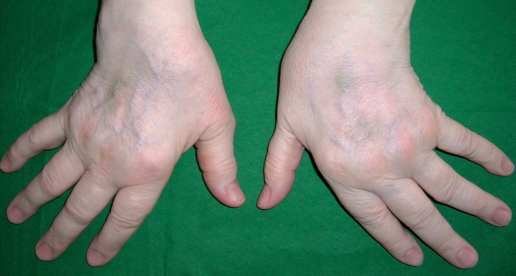 Deformidades de hueso