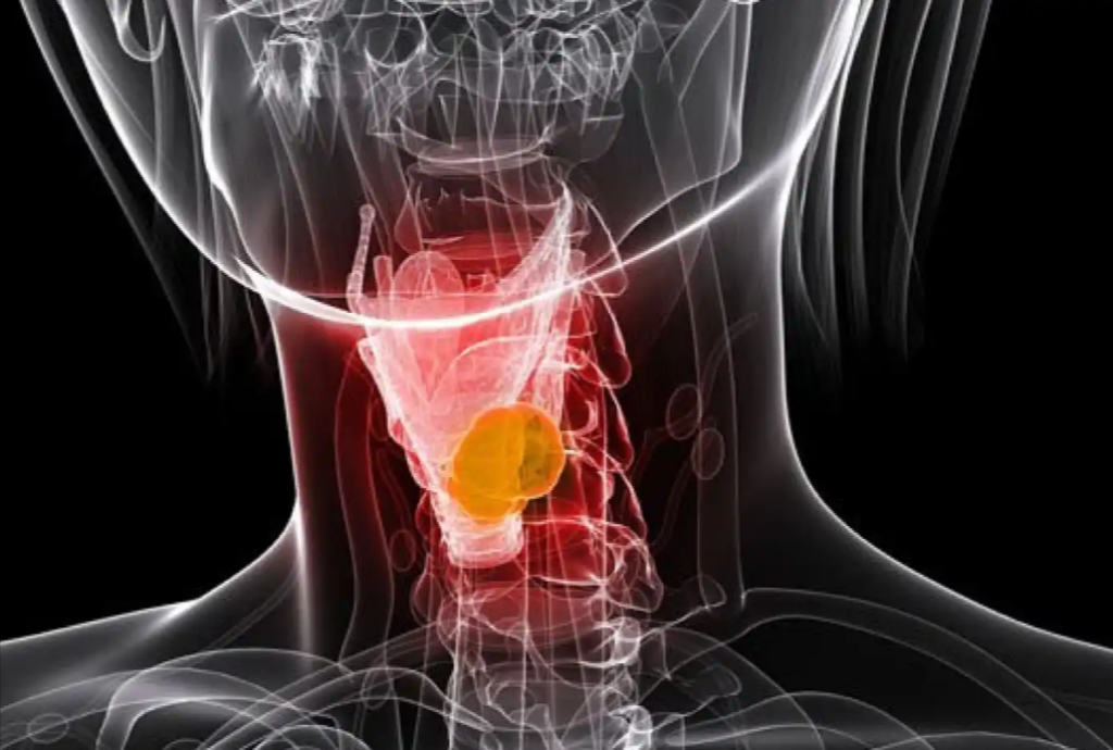 Tumores de la laringe o la orofaringe