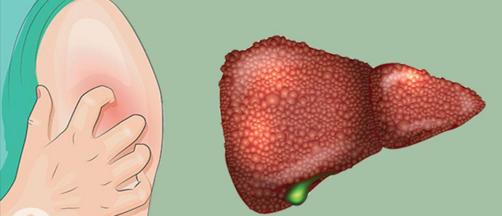 Problemas hepáticos