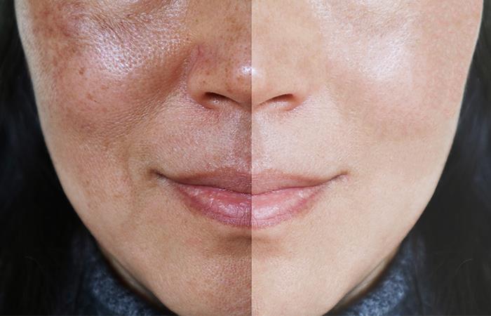 Las manchas en la piel pueden aparecer por desarreglos hormonales.