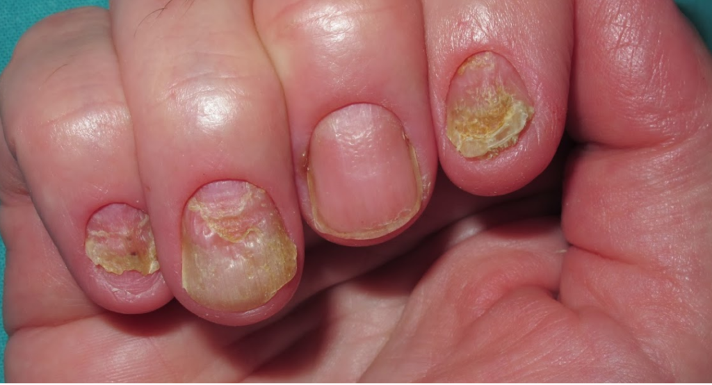 Hongos en las uñas de las manos