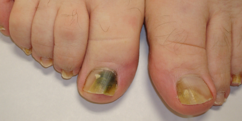 Hongos en las uñas de los dedos gordos de los pies