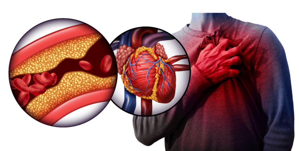 Síntomas de infarto