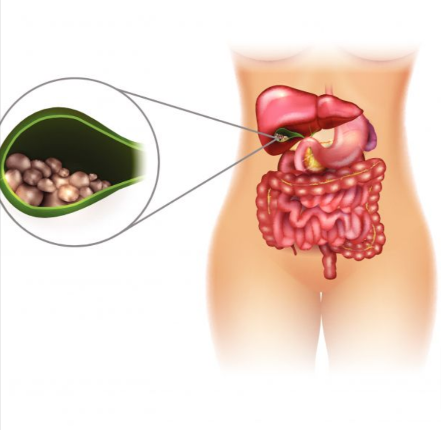 Piedras en la vesícula biliar