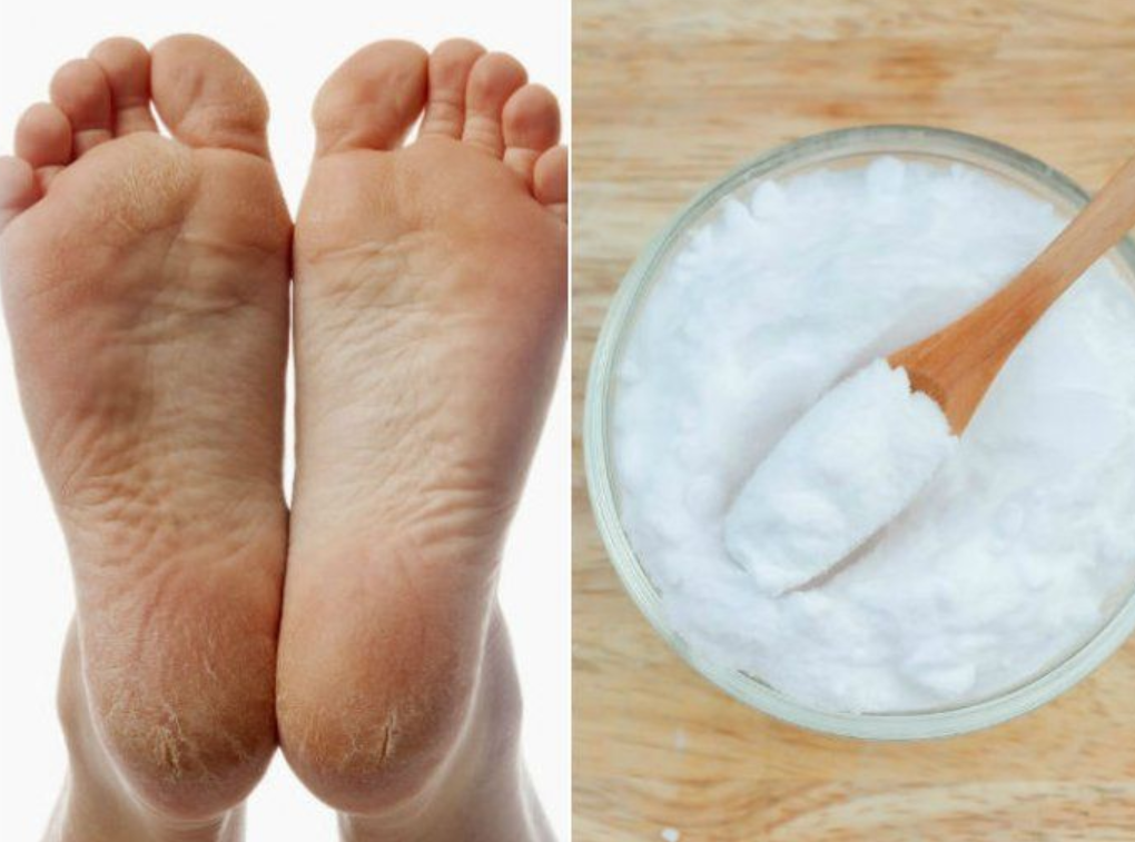 Eliminar talones agrietados con bicarbonato de sodio