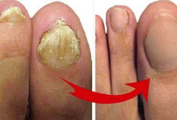 Tratamientos para los hongos en las uñas