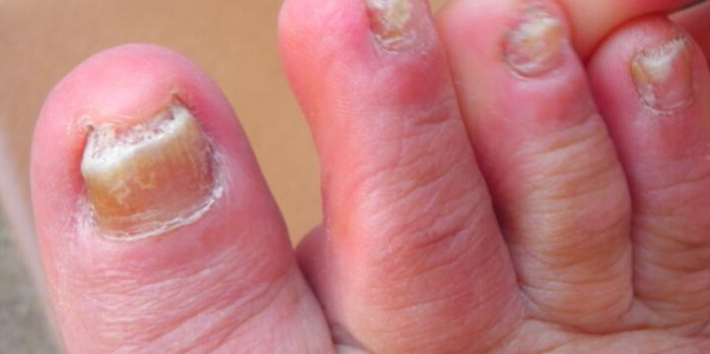 Hongos en las uñas de los pies